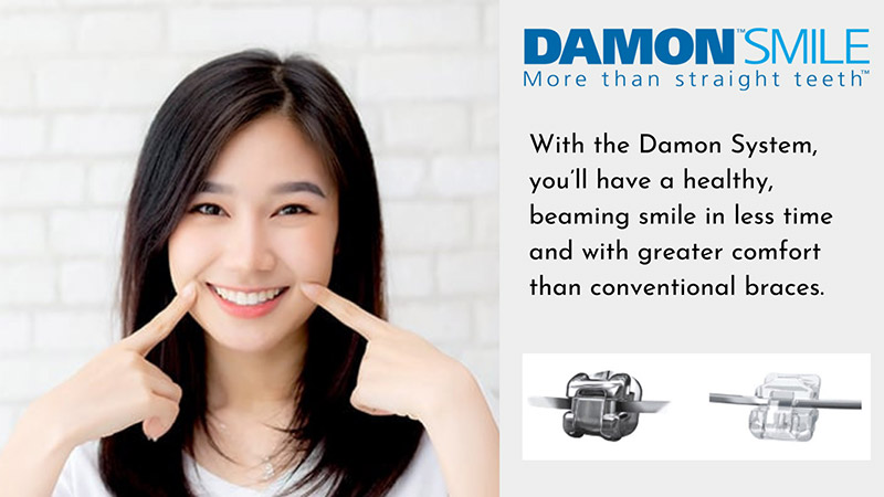 Greater comfort with Damon System braces