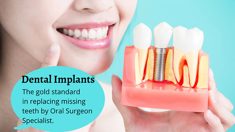 Dental Implants